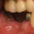 Common Dental Diseases: What You Need to Know