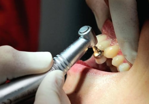 How Much Does a Dentist Cost in Singapore?