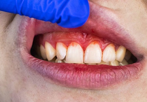 Common Causes of Oral Dental Diseases